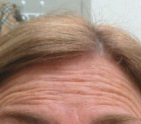 Botox Wrinkle Treatment Edinburgh: A wrinkle creased forehead prior to Botox Wrinkle Treatment as part of a facial rejuvenation procedure by Barron Dental, Leith, Edinburgh.