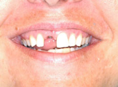 Dental Implants Edinburgh: A mouth with a missing tooth pre dental implants from Barron Dental, Leith, Edinburgh.