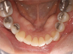 An unattractive mouth with amalgam fillings. Barron Dental provides white fillings in Edinburgh.