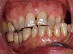 An uneven and discoloured set of teeth prior to dental crown treatment. Contact Barron Dental, Leith for dental crowns, Edinburgh.