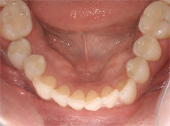 A healthy mouth complete with new, white fillings. Barron Dental, white fillings Edinburgh.