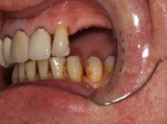 A mouth with a three tooth gap prior to denture implants from Barron Dental, Leith, Edinburgh.