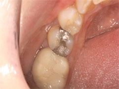 A mouth with an amalgam filling which was subsequently replaced by a new white filling