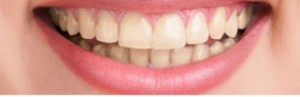 Teeth Whitening Edinburgh: Teeth before teeth whitening at Barron Dental, Leith.