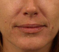 A before photograph of someone prior to Juvederm fillers, wrinkle treatment by Barron Dental, Edinburgh. This was carried out as part of a facial rejuvenation treatment by our dental care specialists.