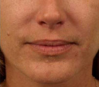 A photograph of a smoother mouth following Botox treatment between a patient's nose and corner of their lips. This wrinkle treatment was carried out as part of a facial rejuvenation procedure by Barron Dental practice, Leith, Edinburgh.