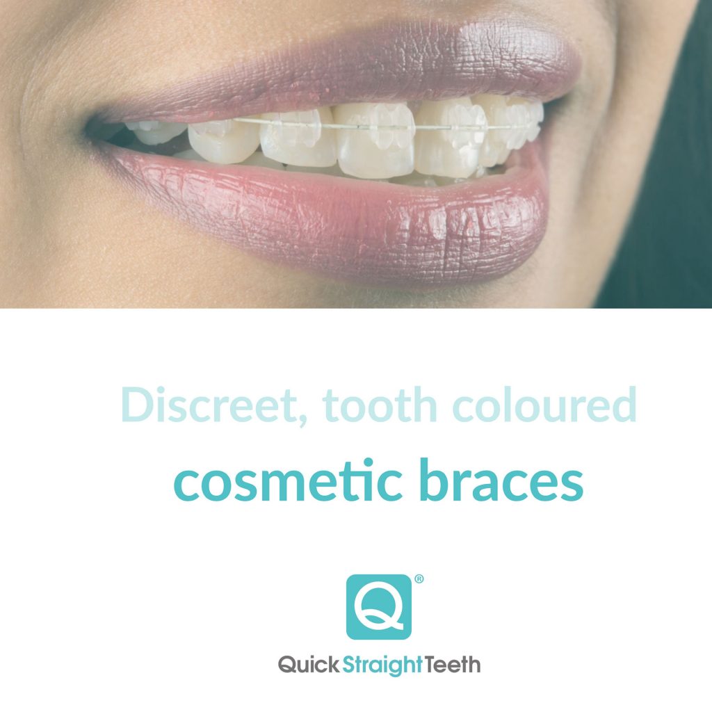 Cosmetic Braces, Short term Braces,Teeth Straightening Edinburgh